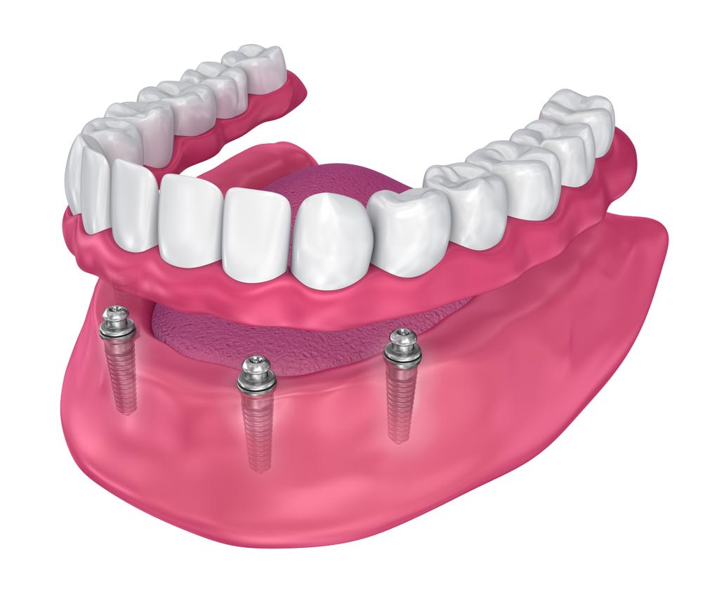 All-on-4 Dental Implants Perth